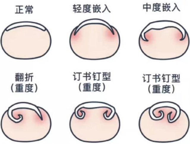 廣西美甲基礎(chǔ)培訓(xùn)：正確修剪指甲的方法
